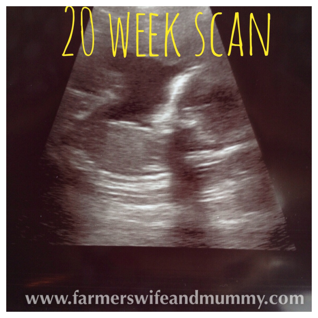 The 20-week scan-what are we having?